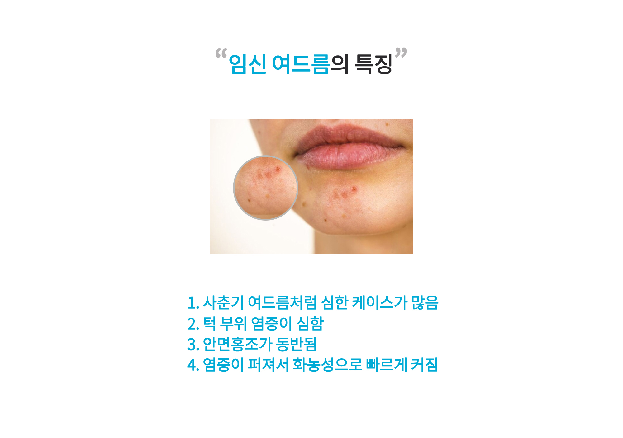 임신여드름