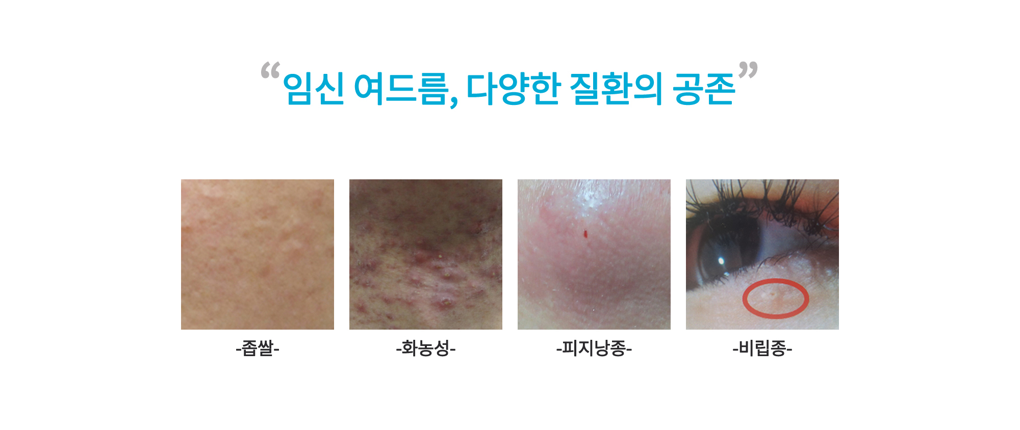 임신여드름