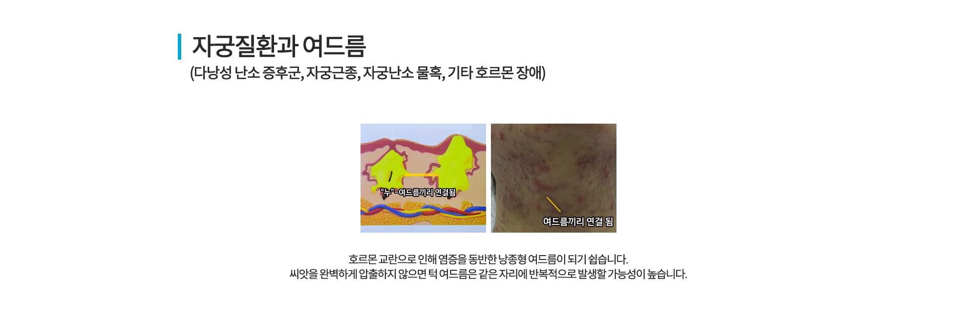 자궁질환 여드름