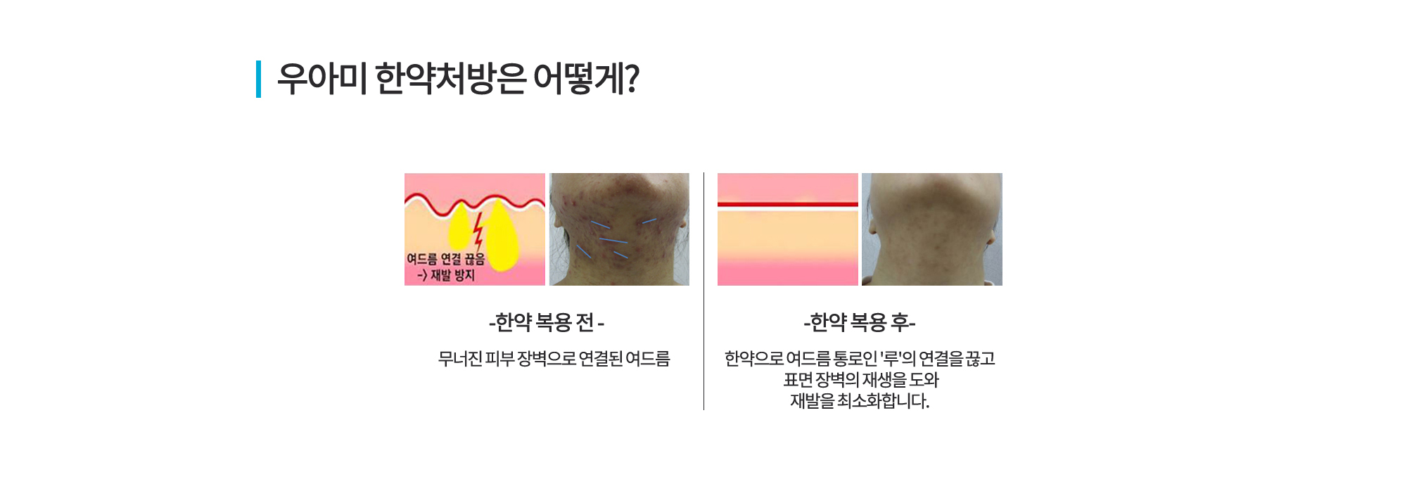 자궁질환 여드름