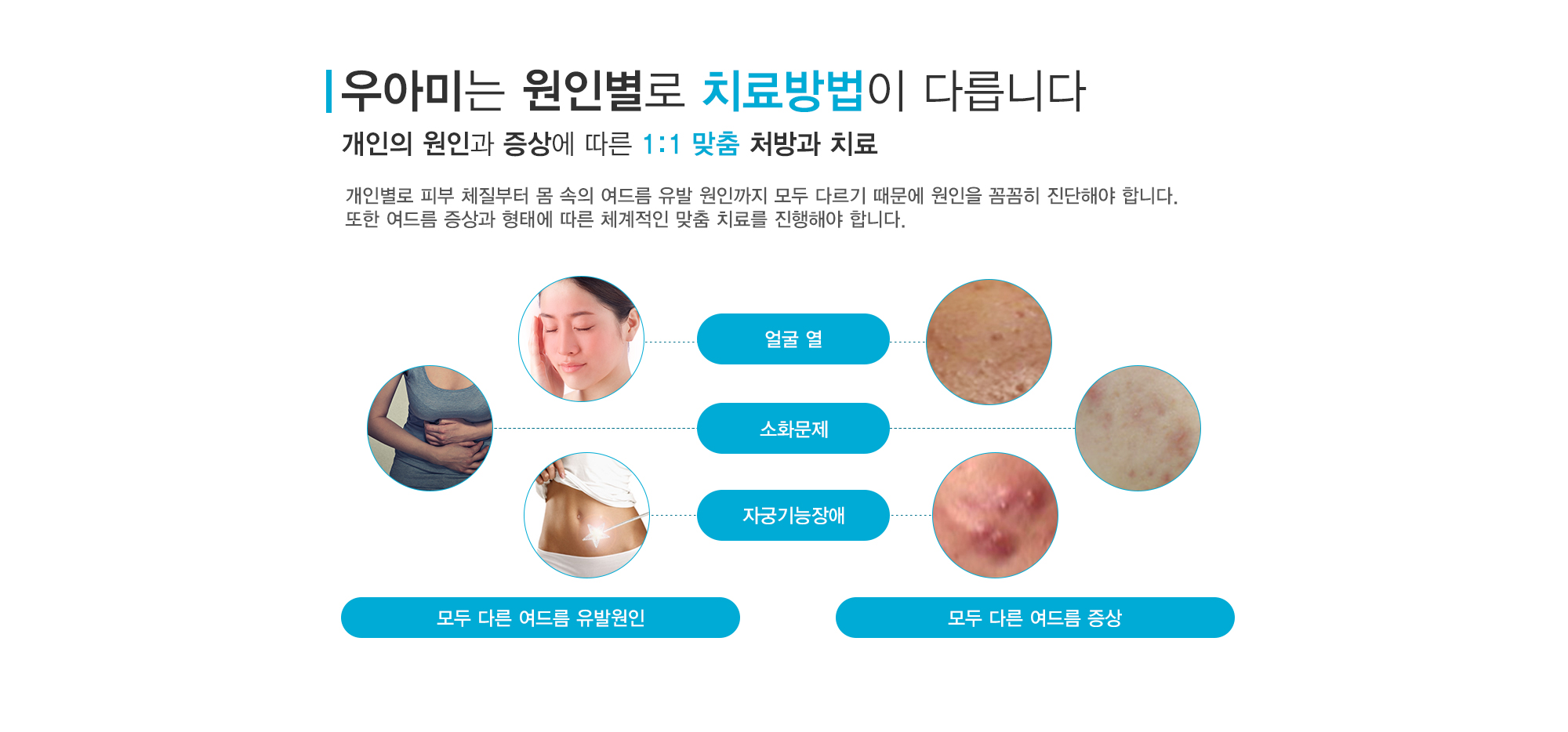 여드름이란?