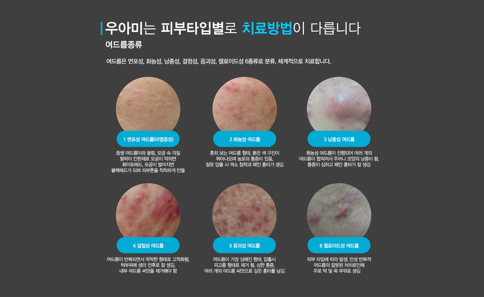 여드름이란?