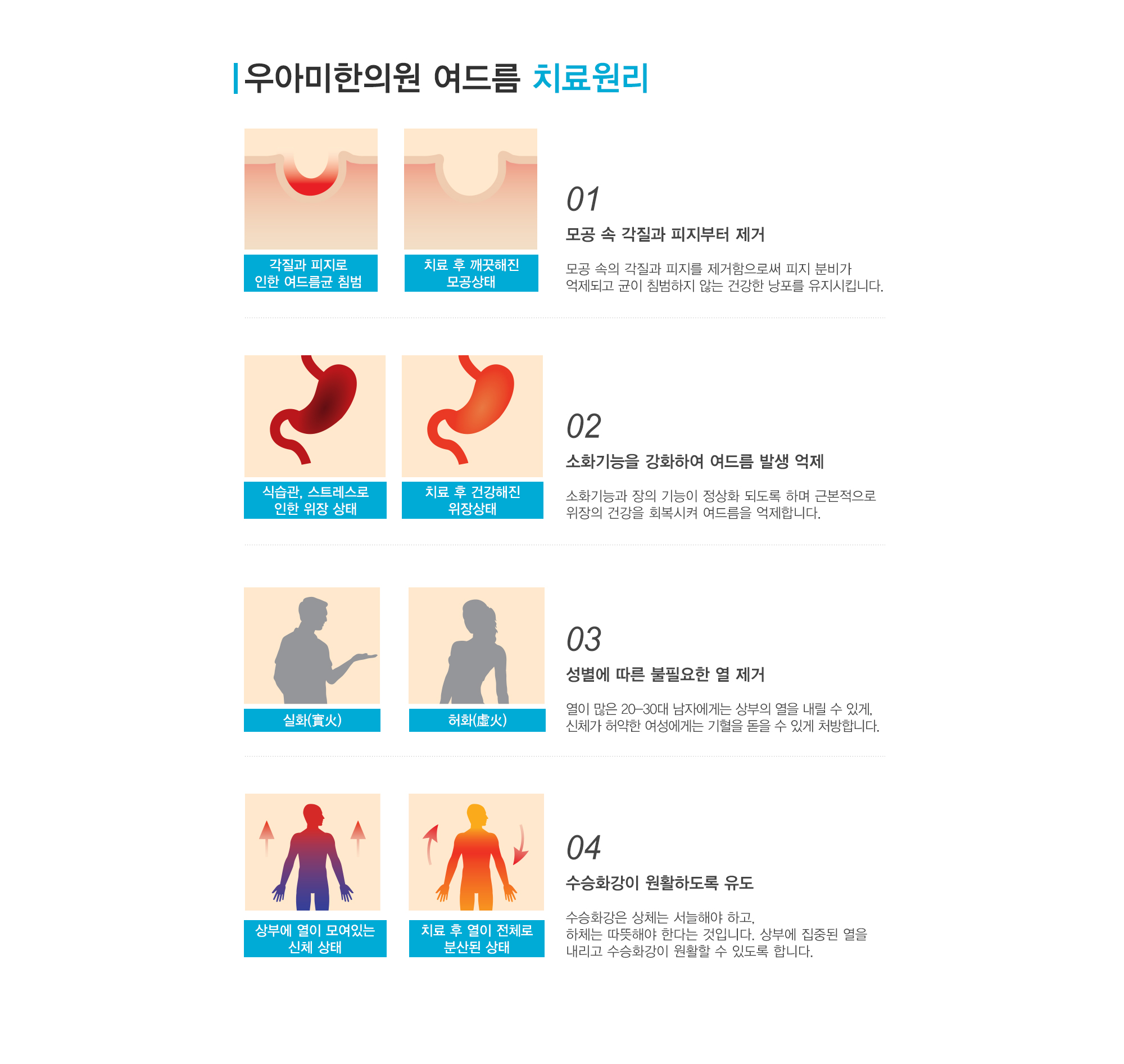 여드름이란?