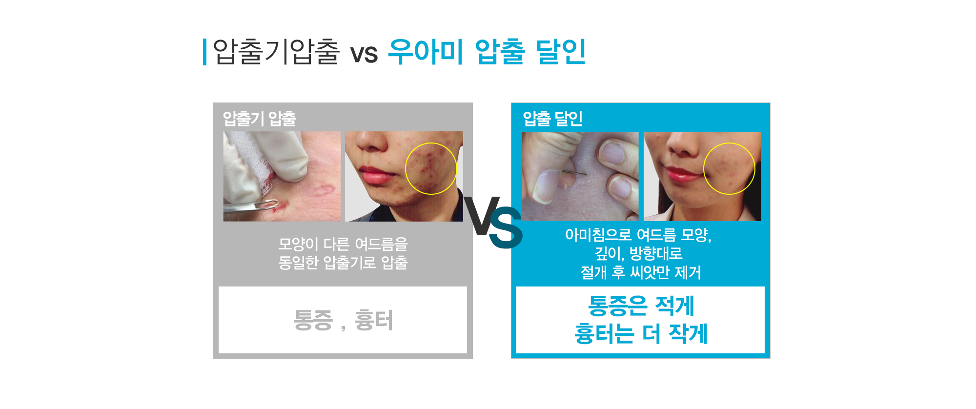 여드름이란?