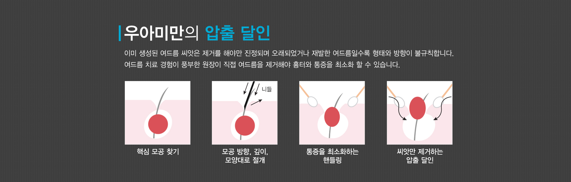 여드름이란?