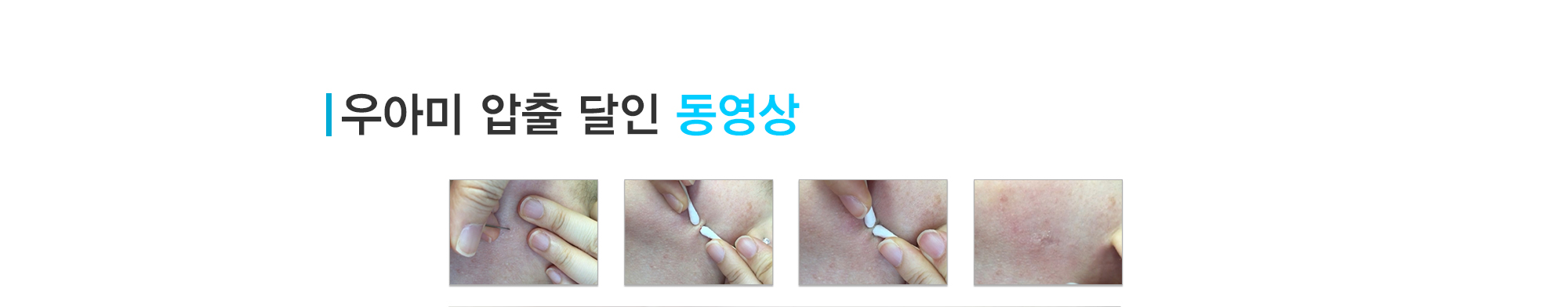 여드름이란?