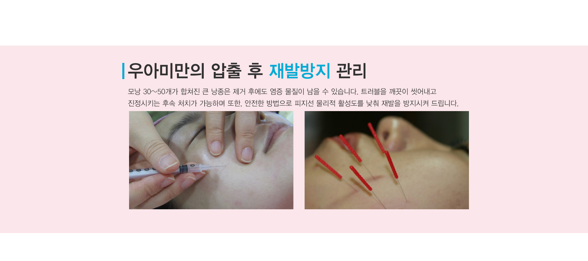 여드름이란?