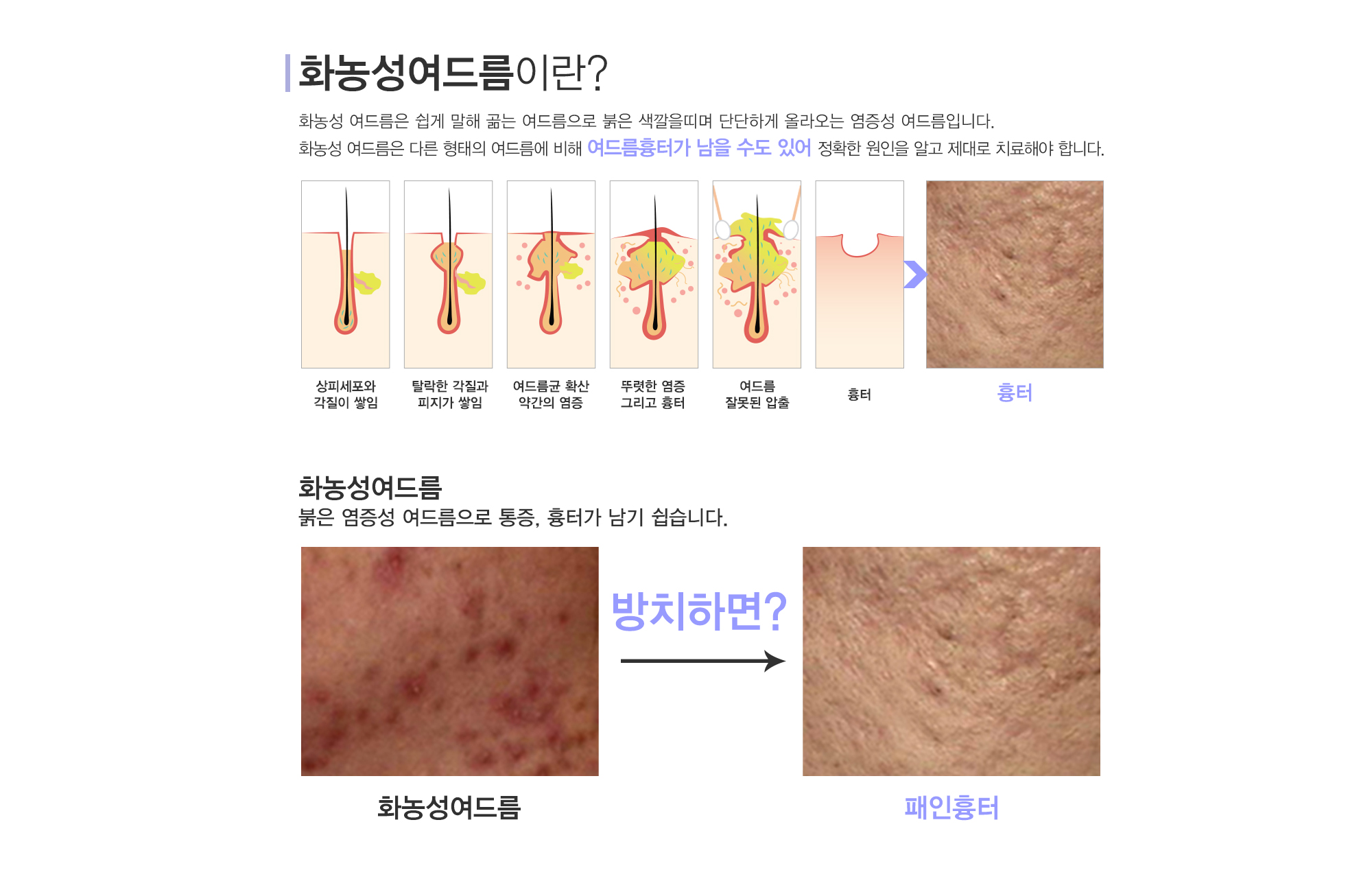 여드름이란?