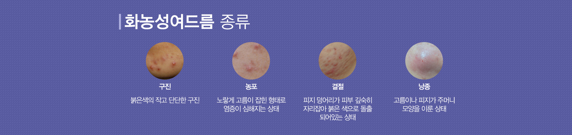 여드름이란?