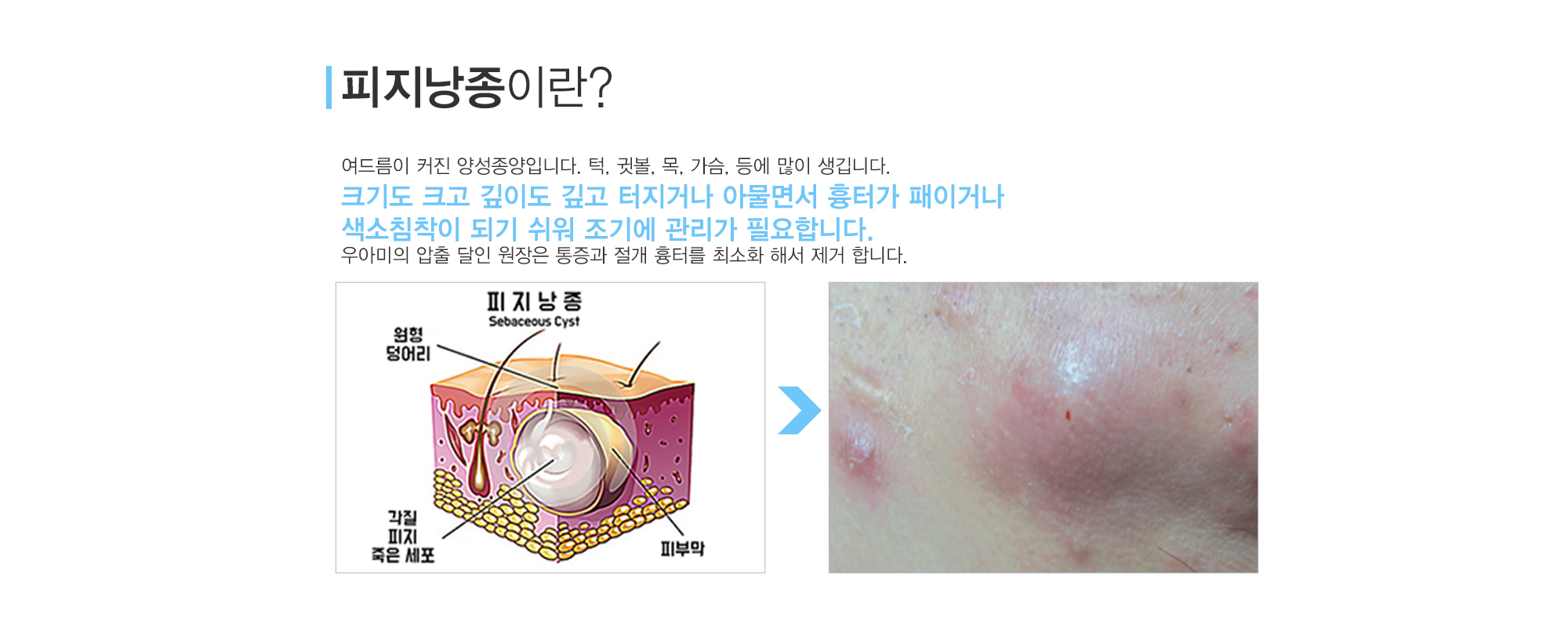 여드름이란?