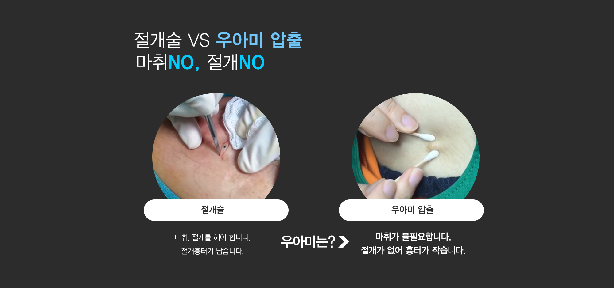 여드름이란?