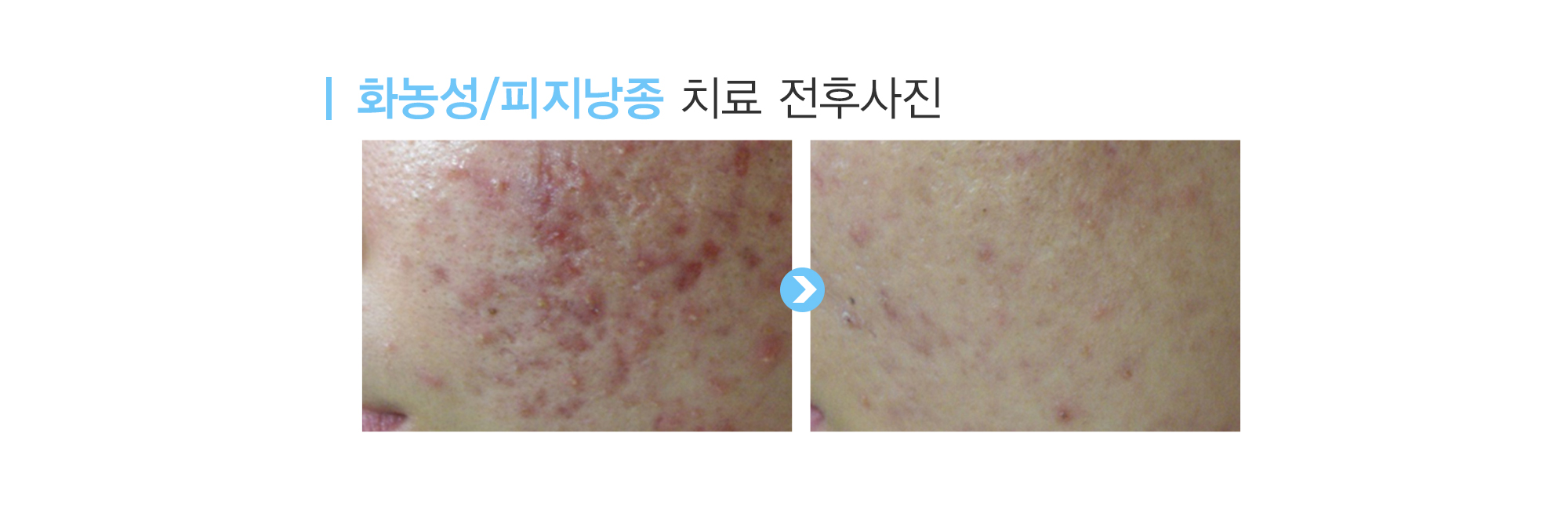 여드름이란?