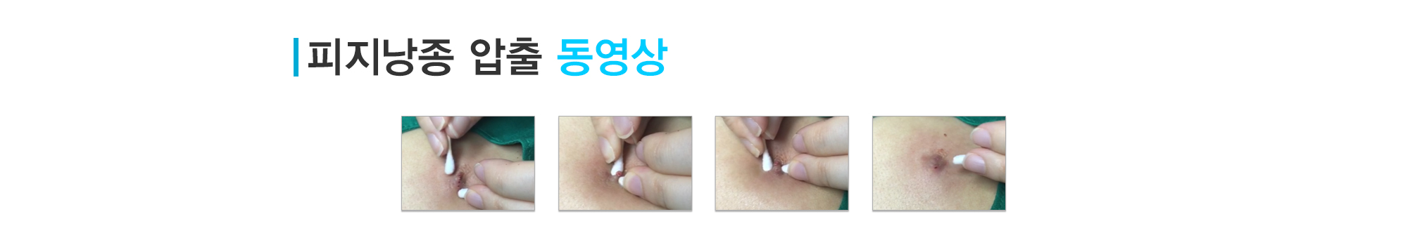 여드름이란?