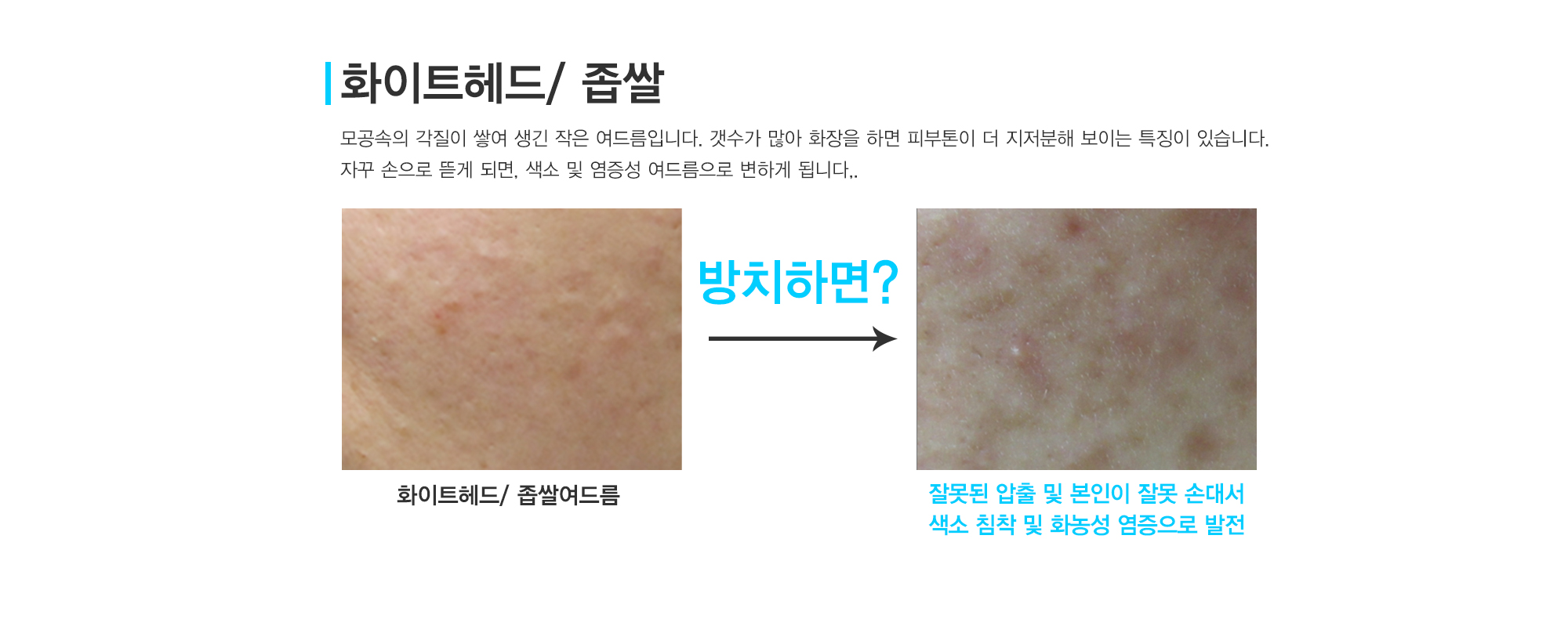 여드름이란?