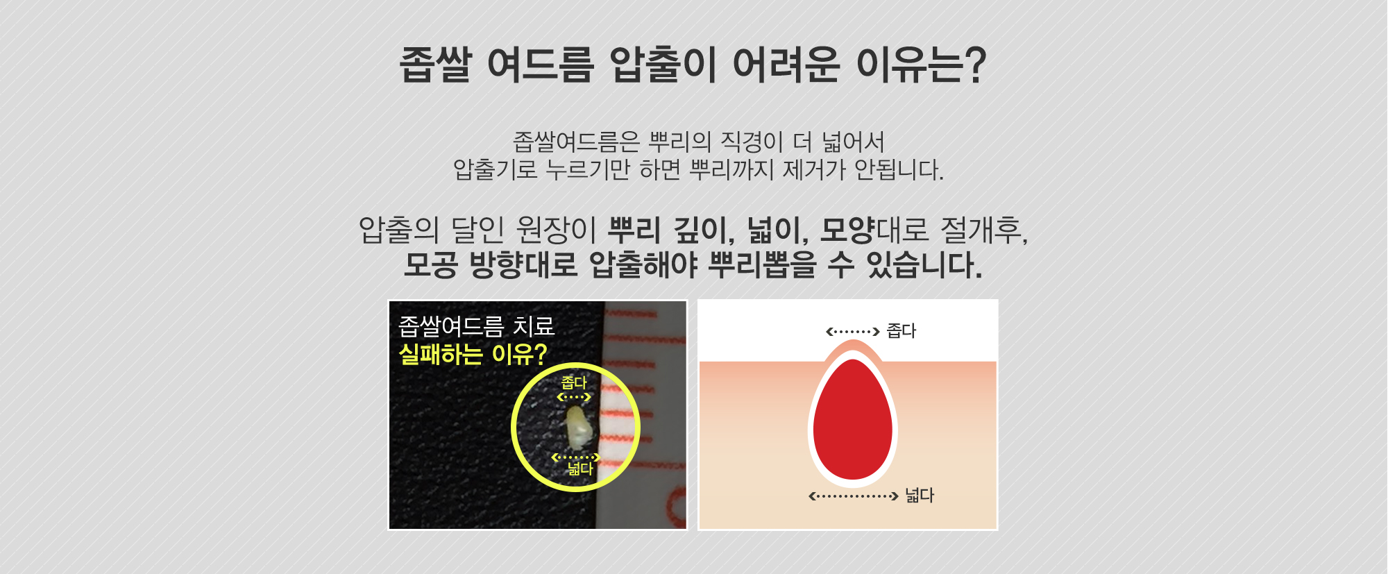 여드름이란?
