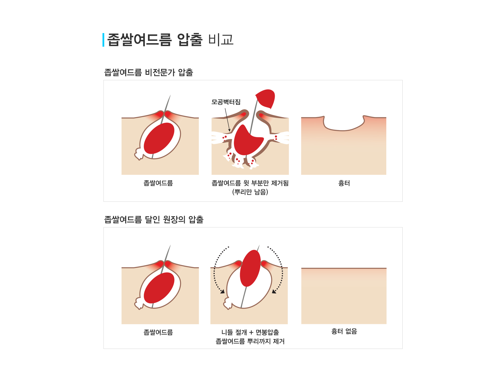 여드름이란?