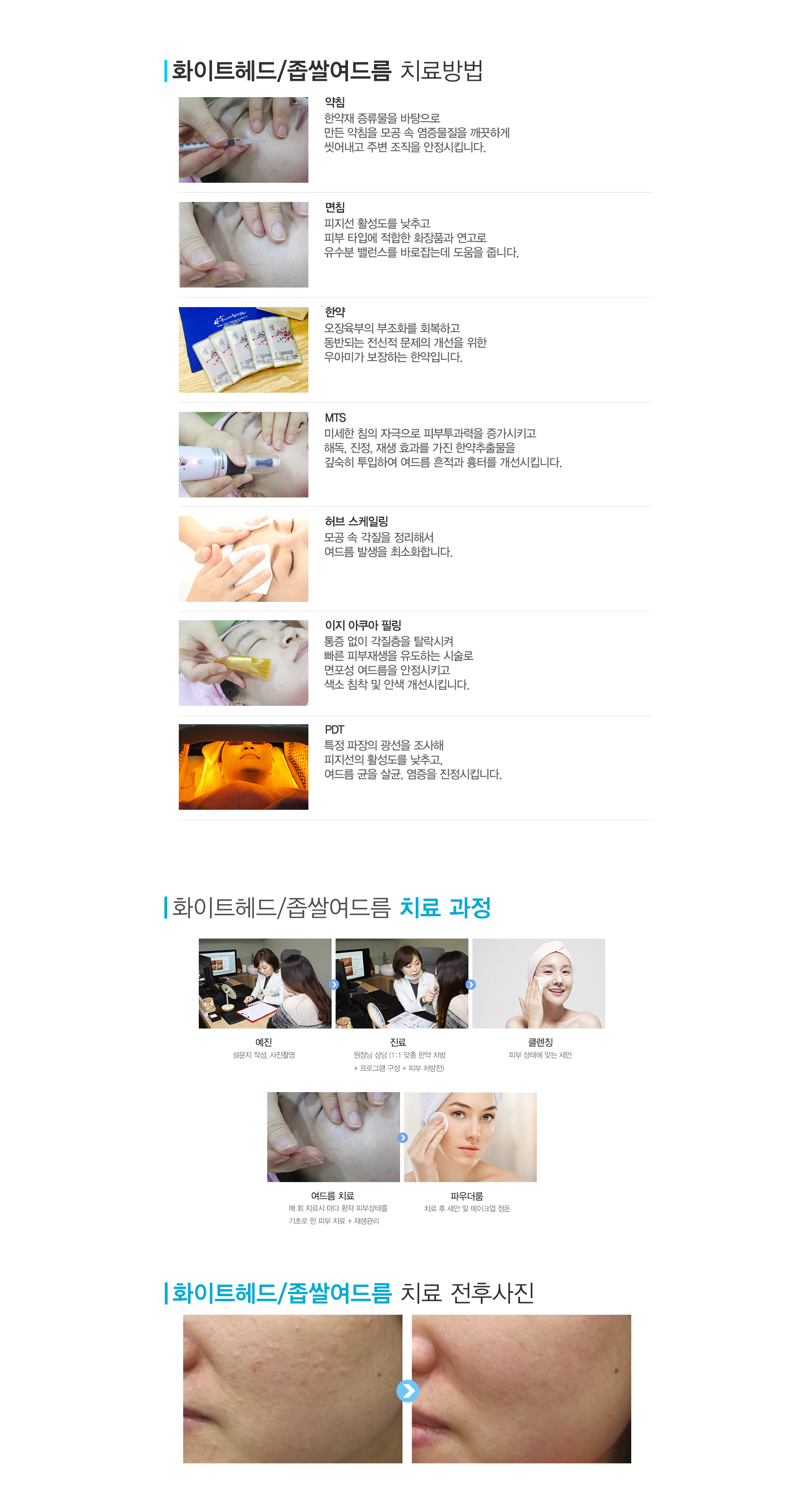여드름이란?