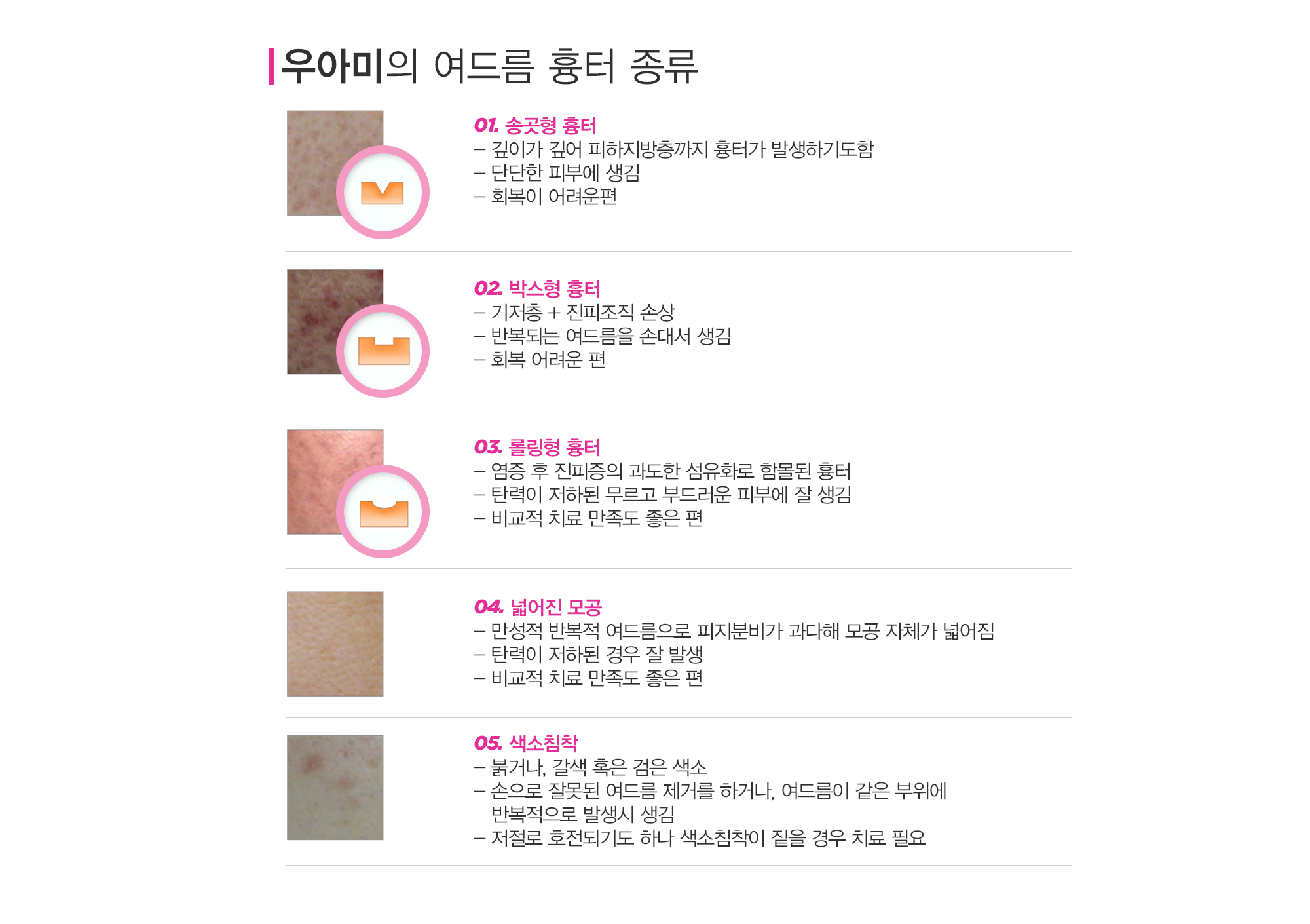 여드름이란?