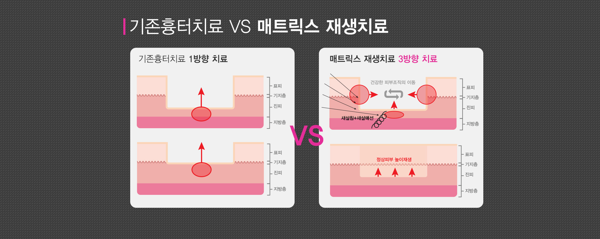 여드름이란?