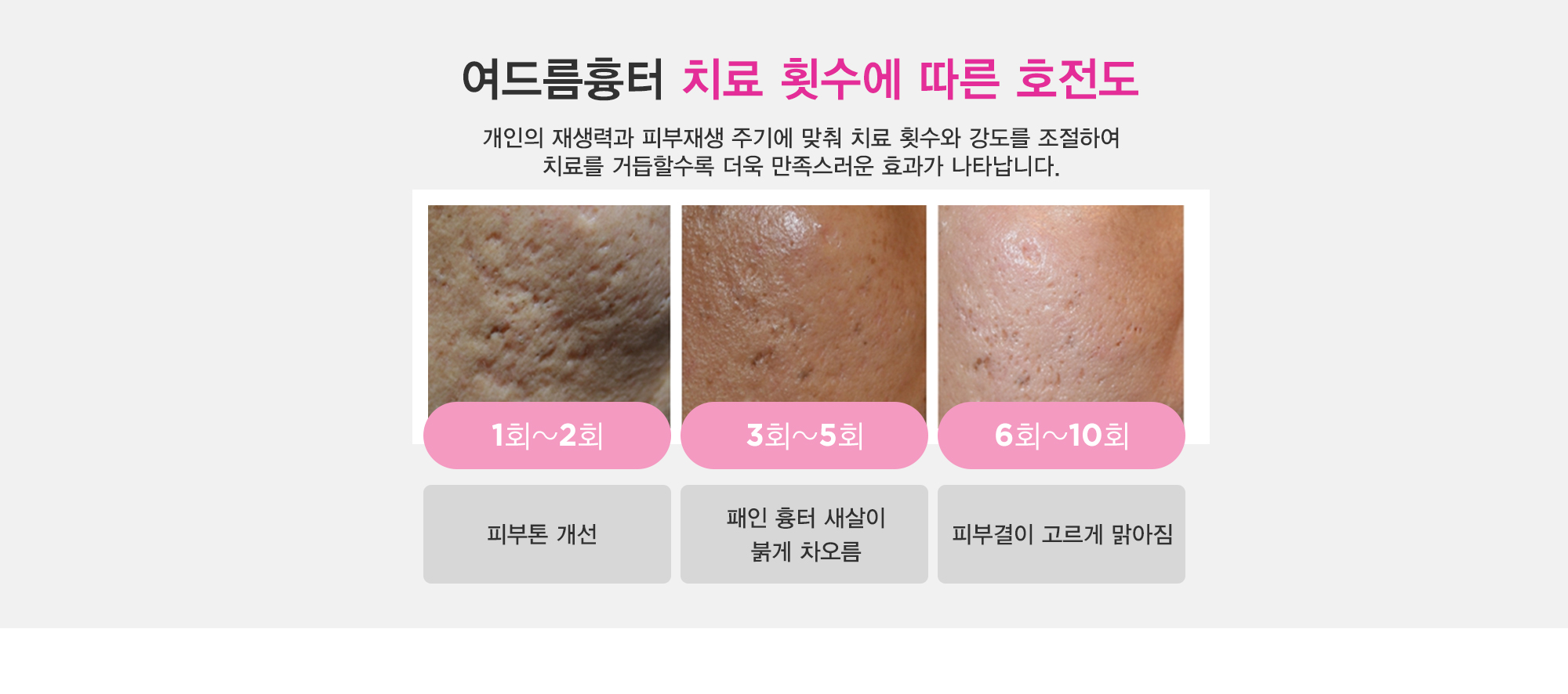 여드름이란?