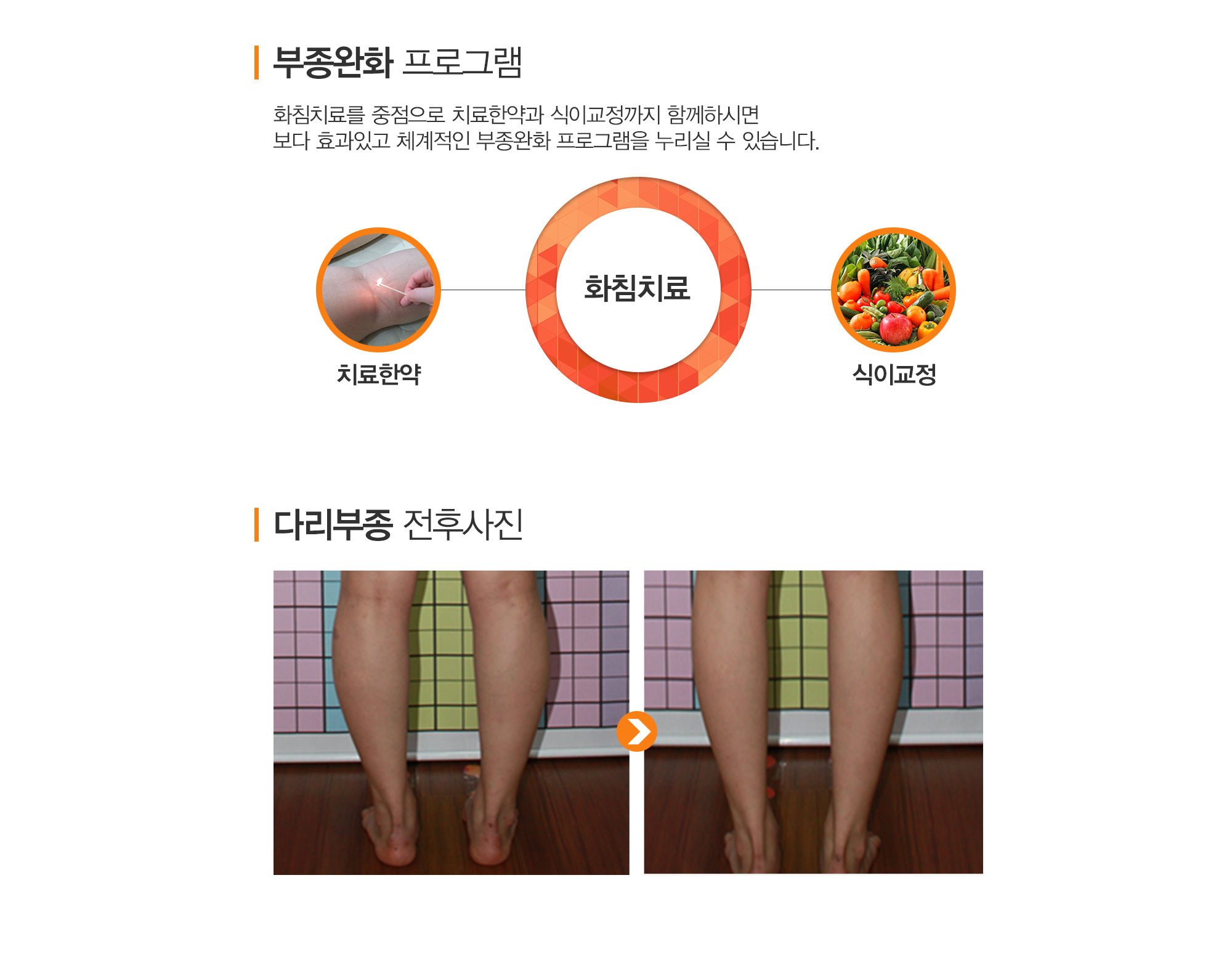부종