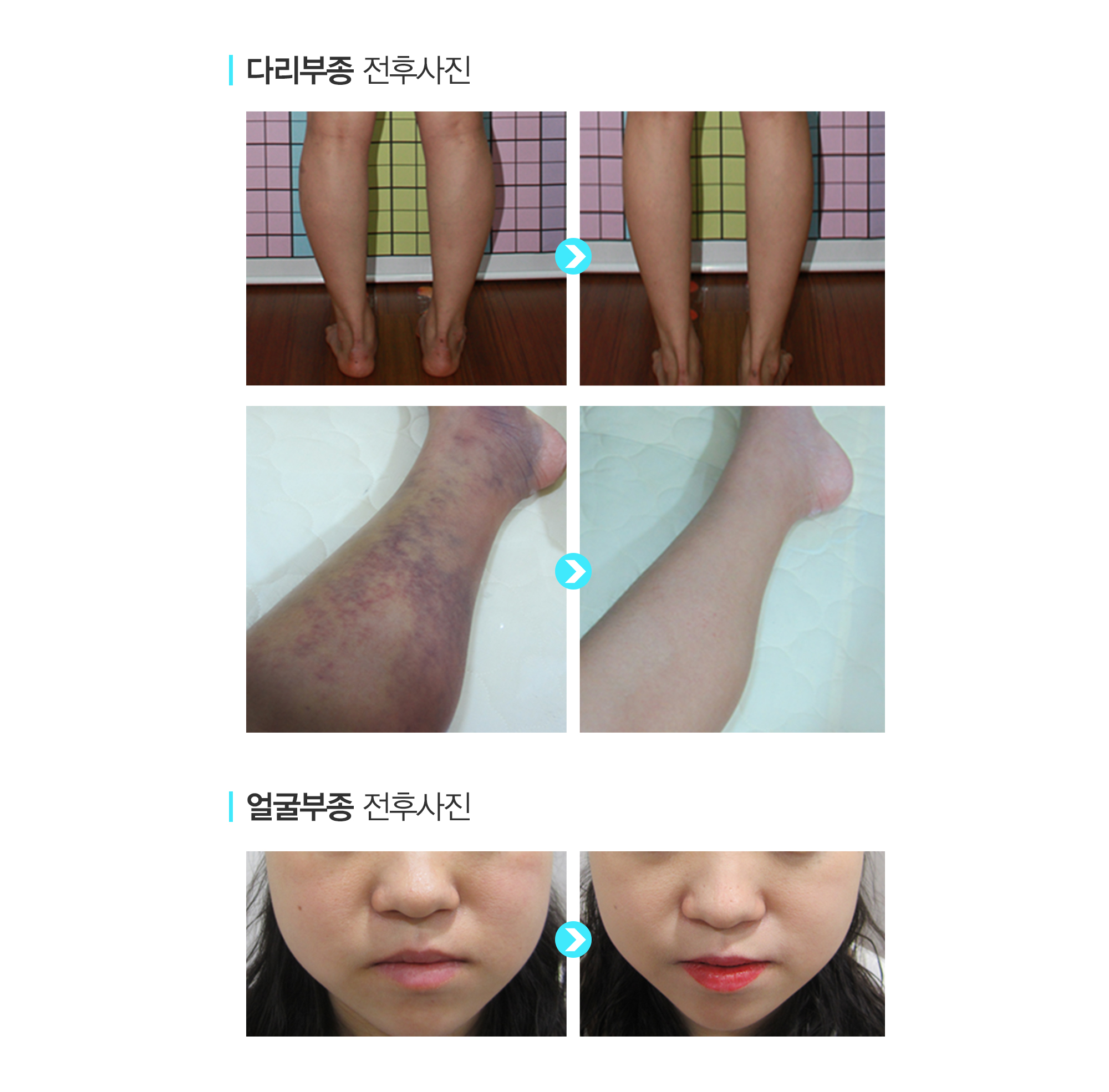부종