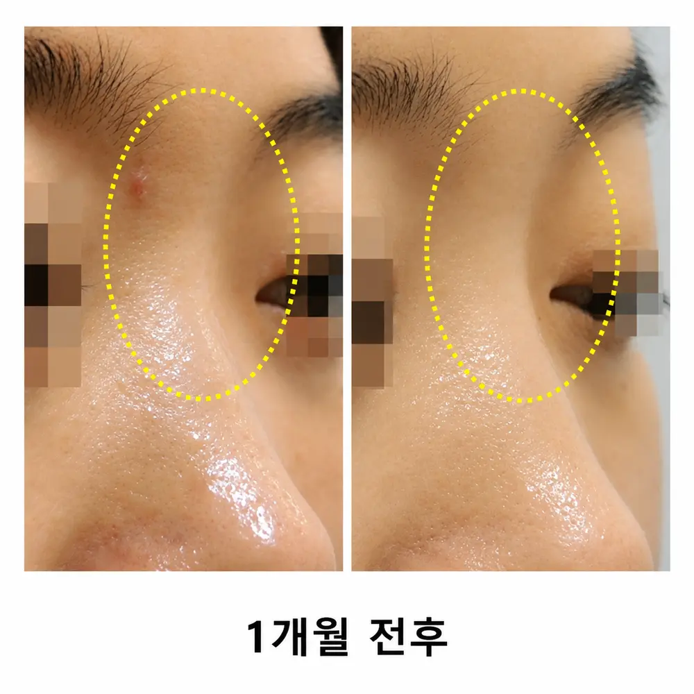 옆에서 본 콧대 라인
