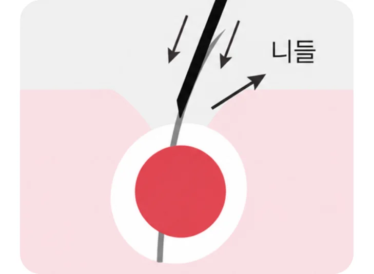 니들로 모공을 여는 방향과 깊이를 표현한 그림