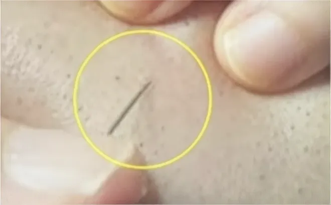 침으로 병변의 중심을 잡는 확대 사진