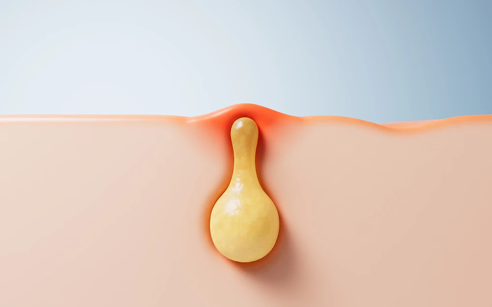 모공 막힘