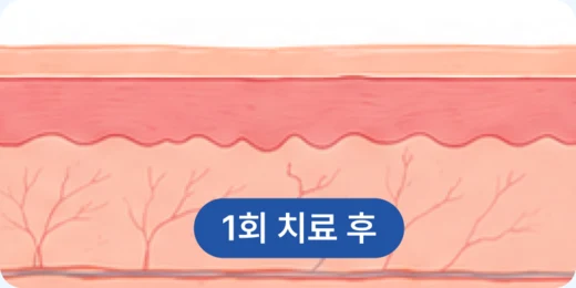 1회 치료 후 피부 단면 그림