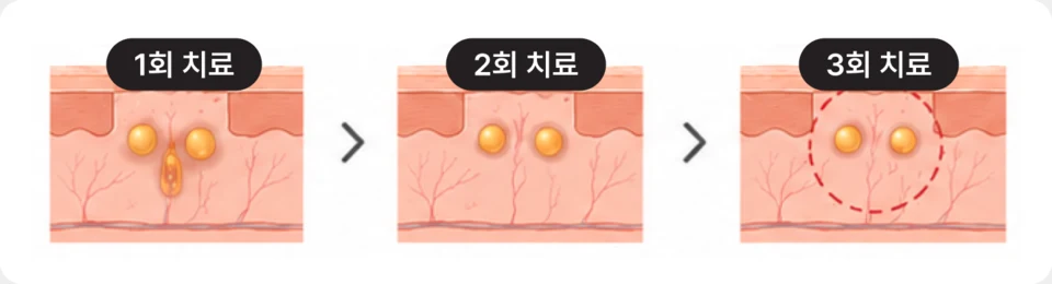 1차 · 2차 · 3~4차 치료 후 변화를 나란히 보여주는 그림