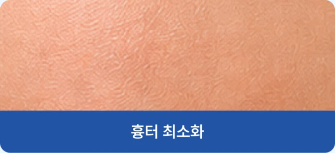 흉터가 최소화된 피부 사진