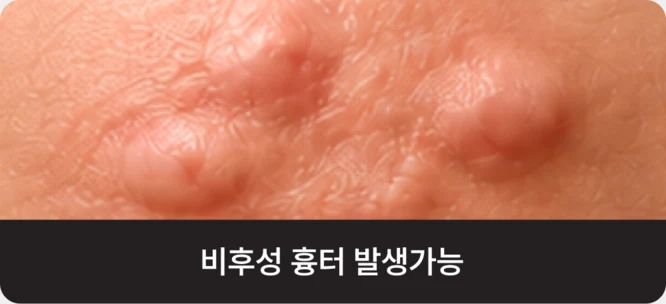 비후성 흉터가 생긴 피부 사진