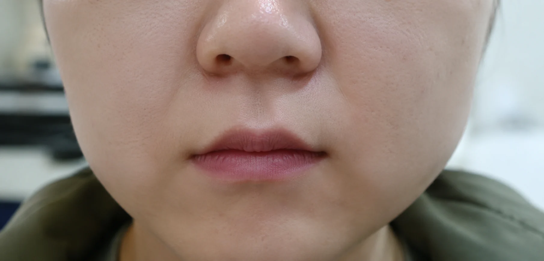 성형수술 후 부작용
흉살, 유착, 바이오본드, 뭉침, 울퉁불퉁 생기는 이유?