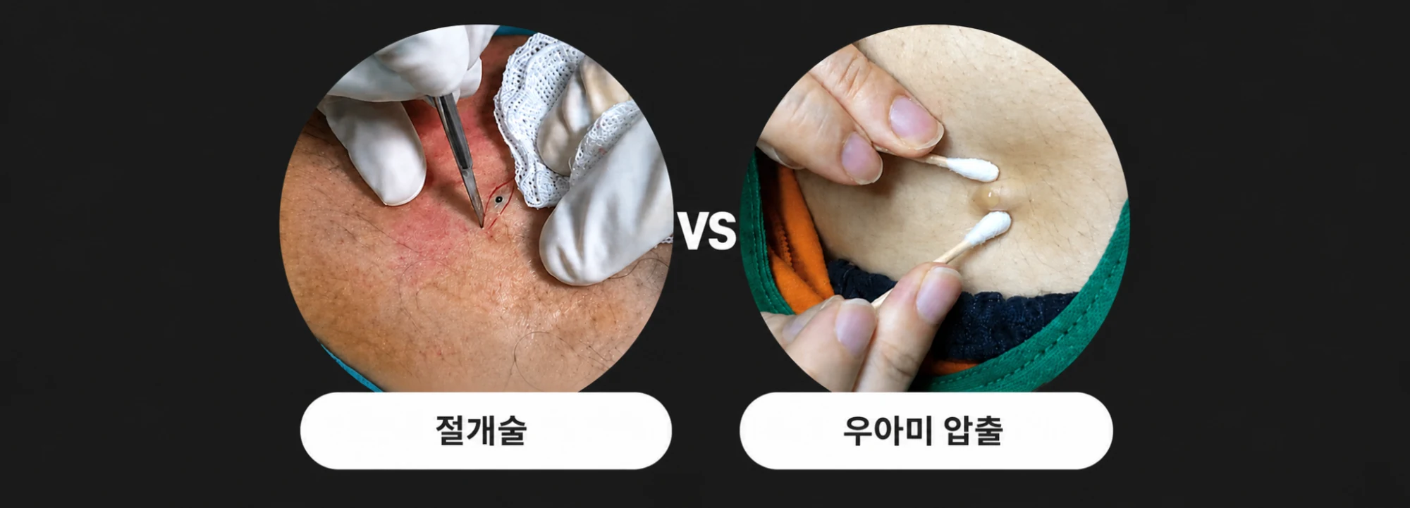 수술 절개와 흉터 부담을 줄인
비절개 압출로