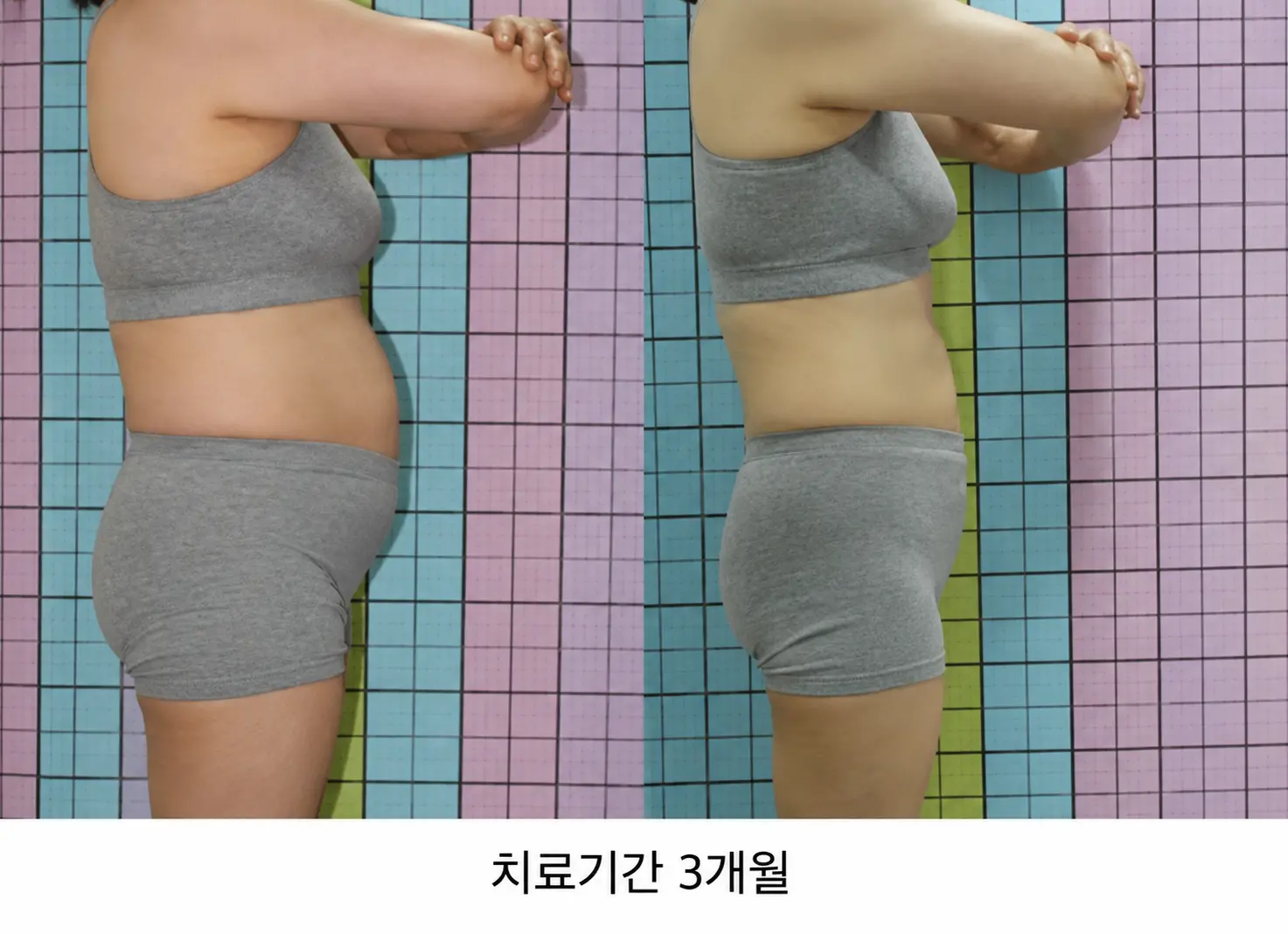 항호르몬치료 후 체중이 늘고 붓는 이유