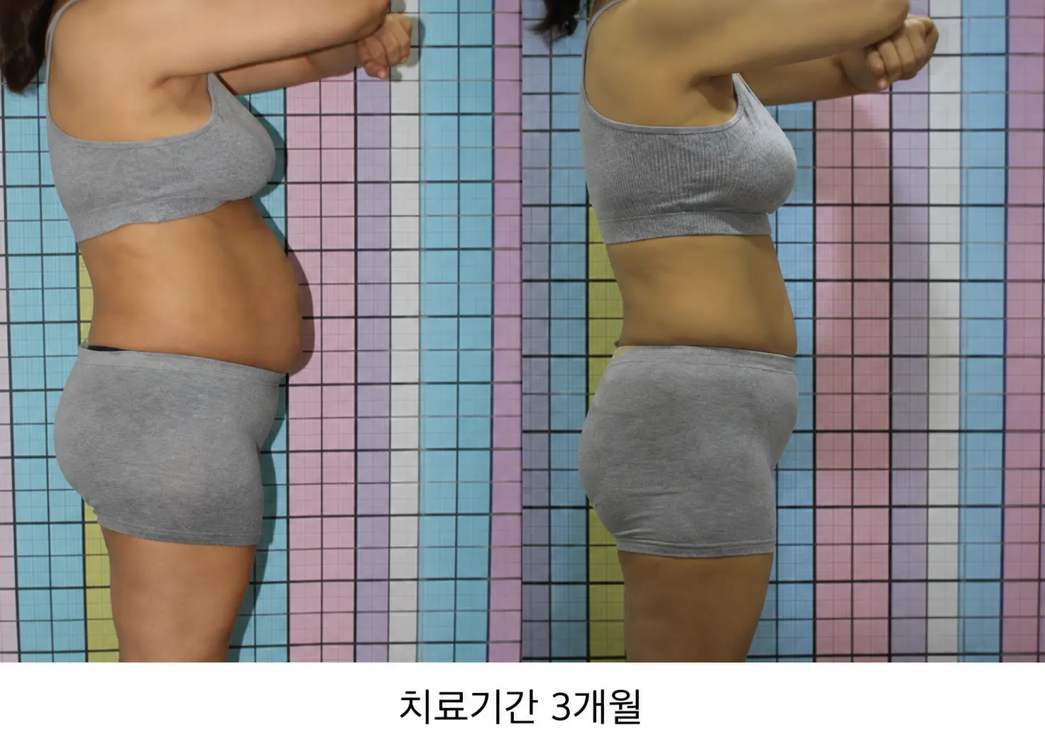 메티마졸 복용 후 살이 찌는 이유