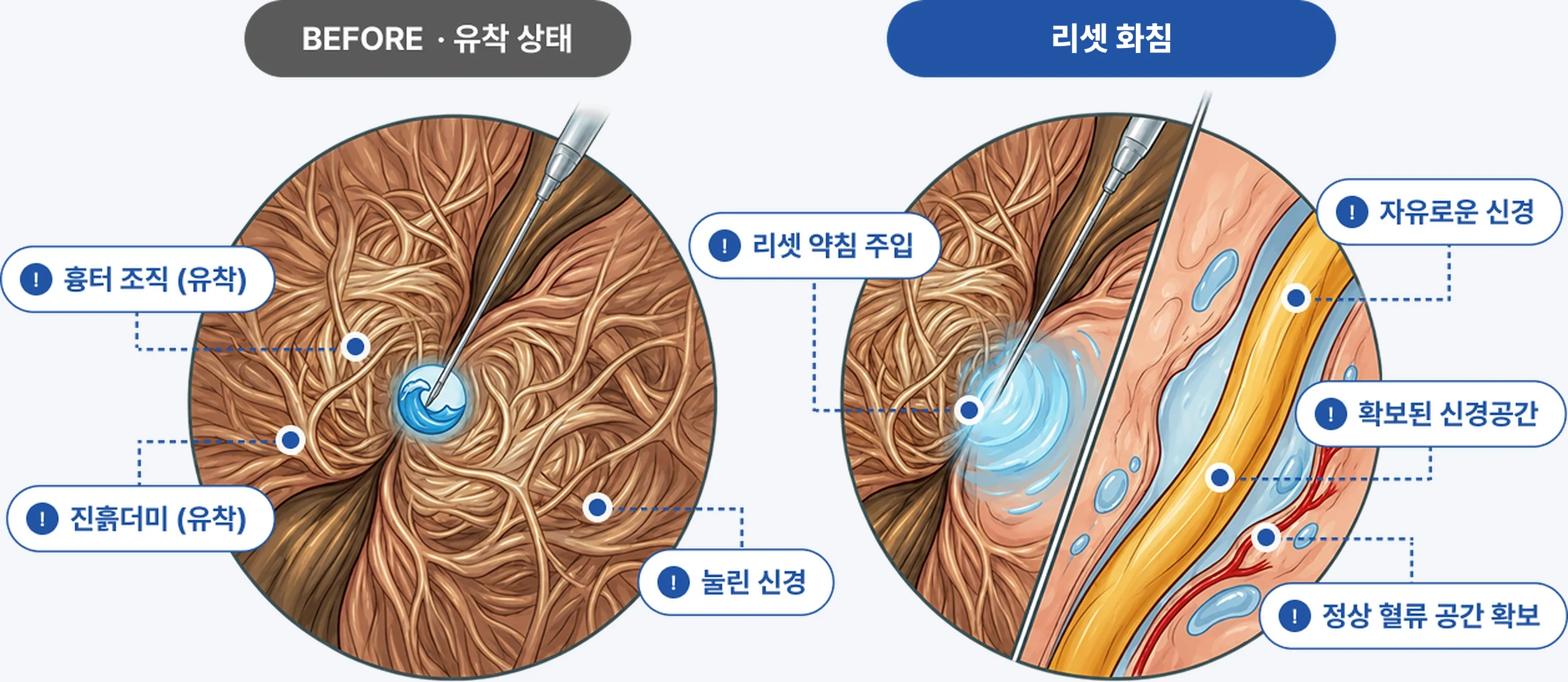 약침 박리 전후 비교 도해 — 유착으로 눌려 있던 신경 주변이 박리 후 열려 혈류 공간이 확보된 모습