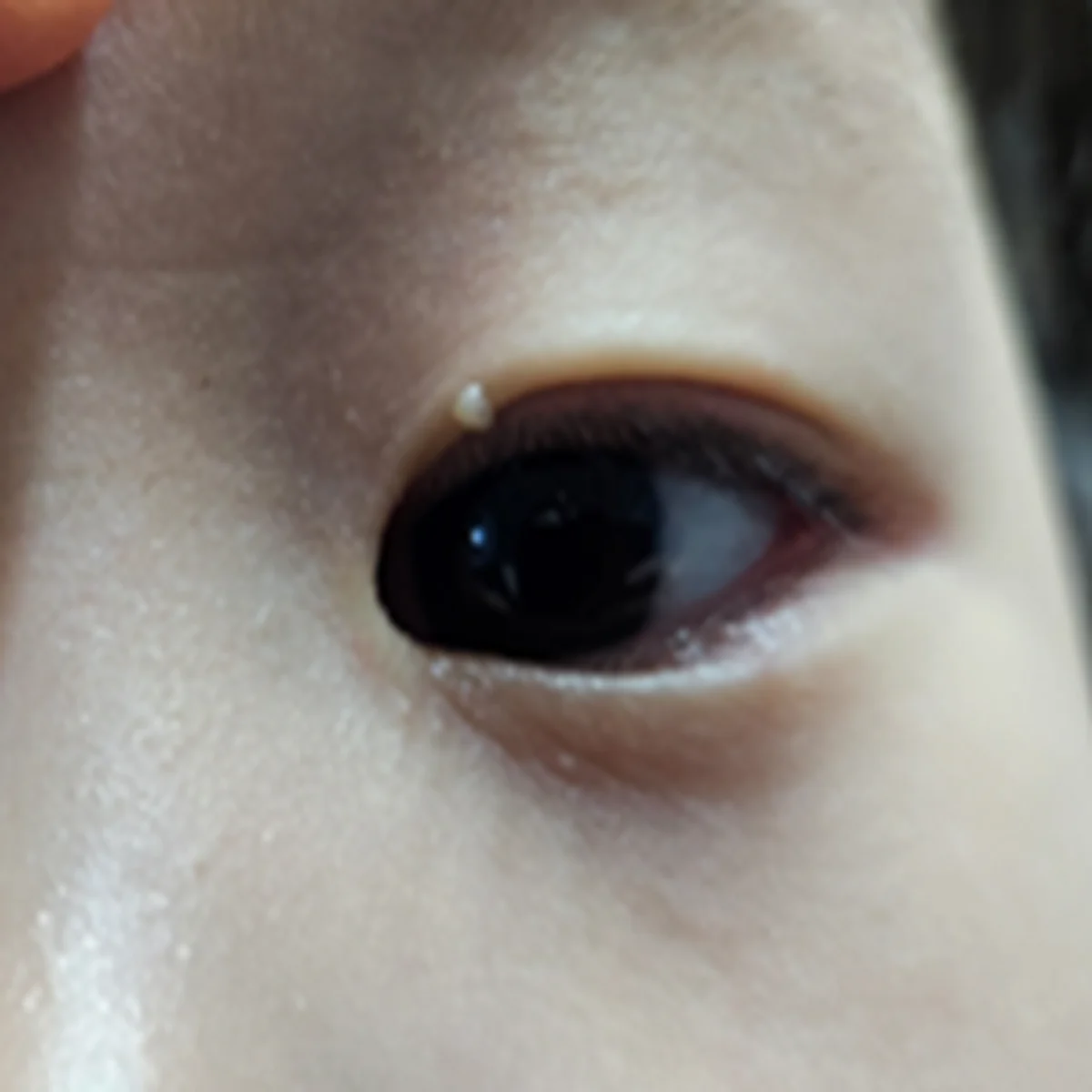 약물 · 레이저가 어려운 경우도 고려합니다.