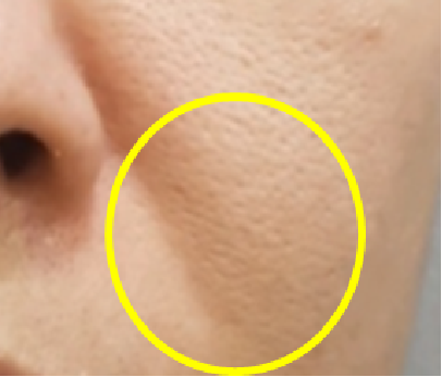 치료 후
