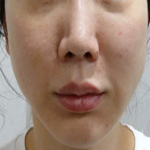 치료 후