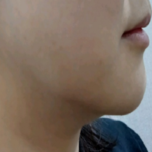 치료 전