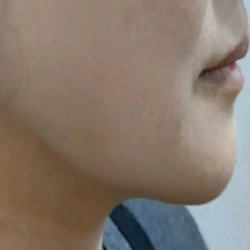 치료 후