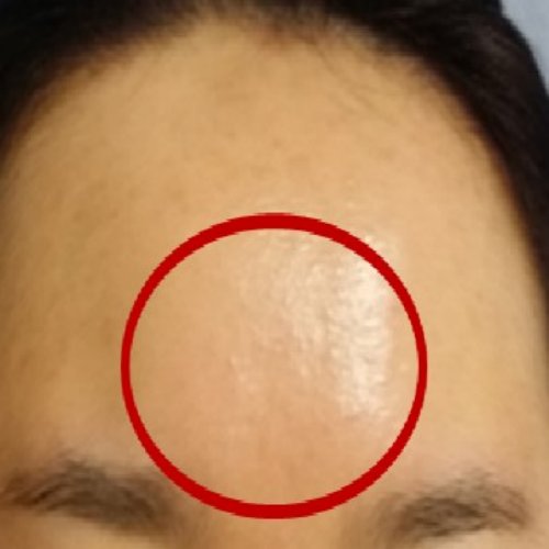 치료 후