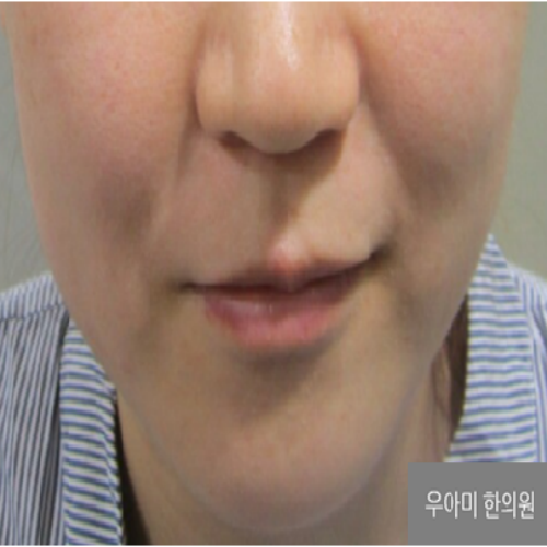 치료 전