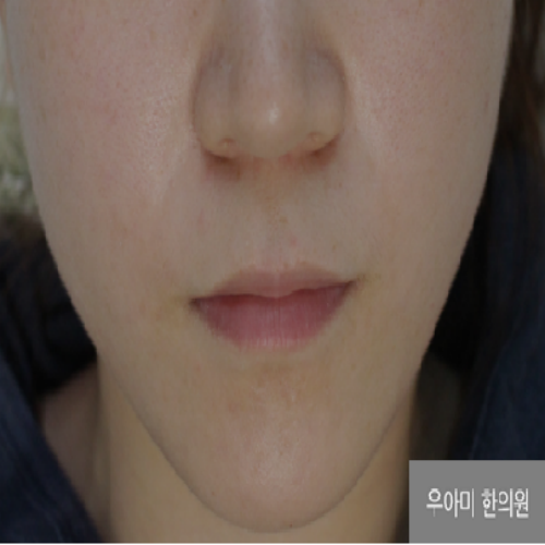 치료 후