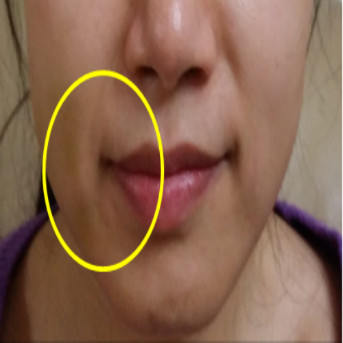 치료 후