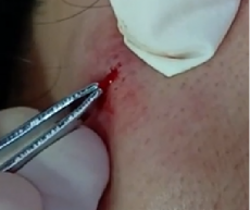 치료 후