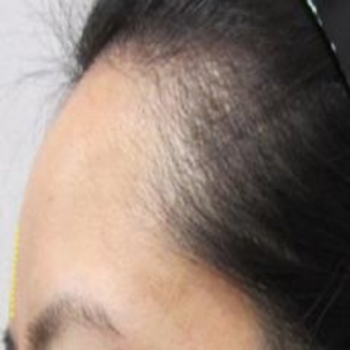 치료 후